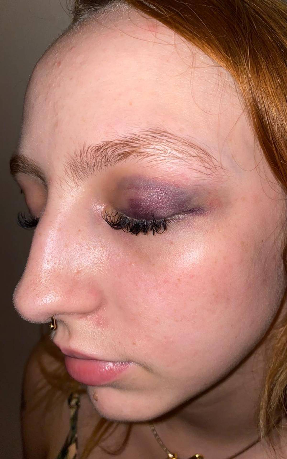 Clara Maya ficou com o olho roxo ap&oacute;s ser agredida por Djalma Junior, filho do ex-jogador Djalminha 