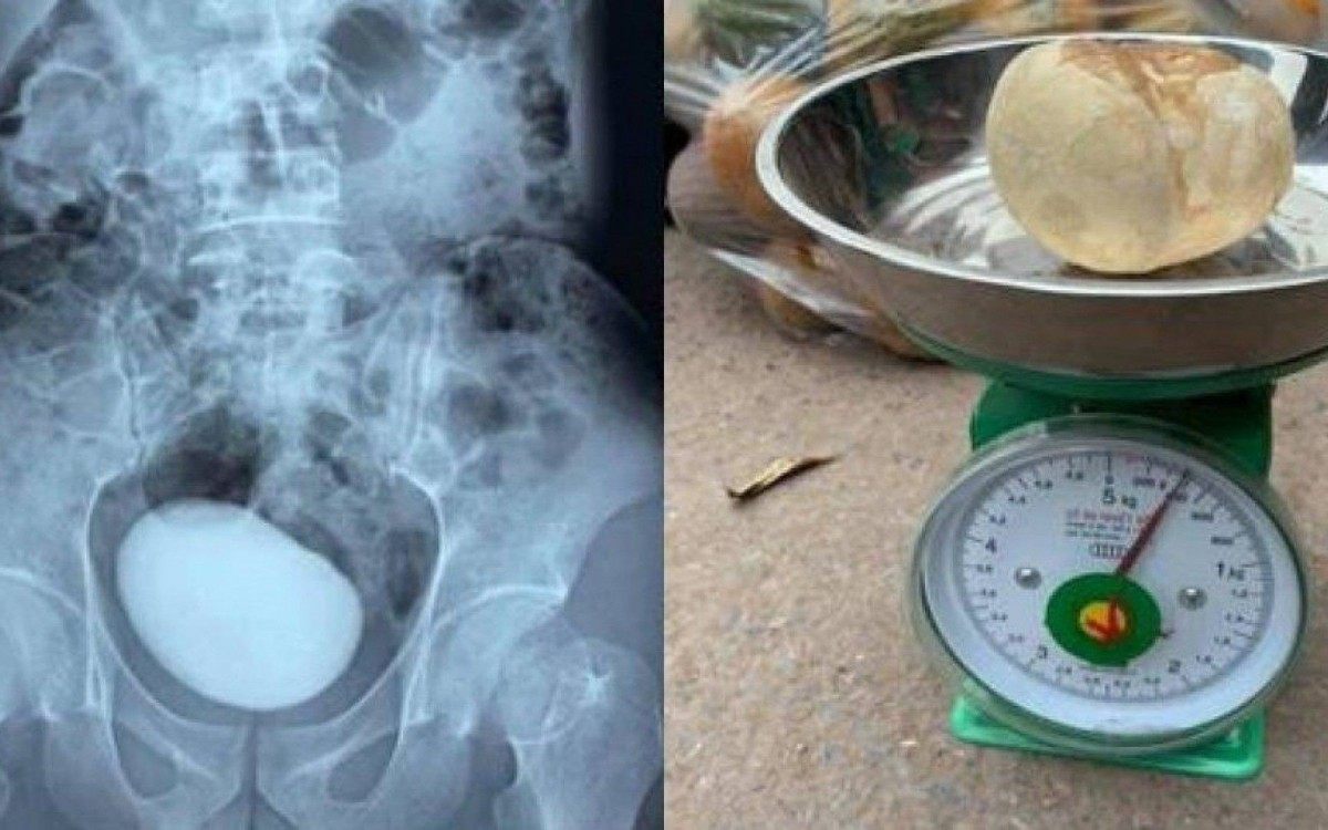 Pedra na bexiga - REPRODUÇÃO CLARÍN