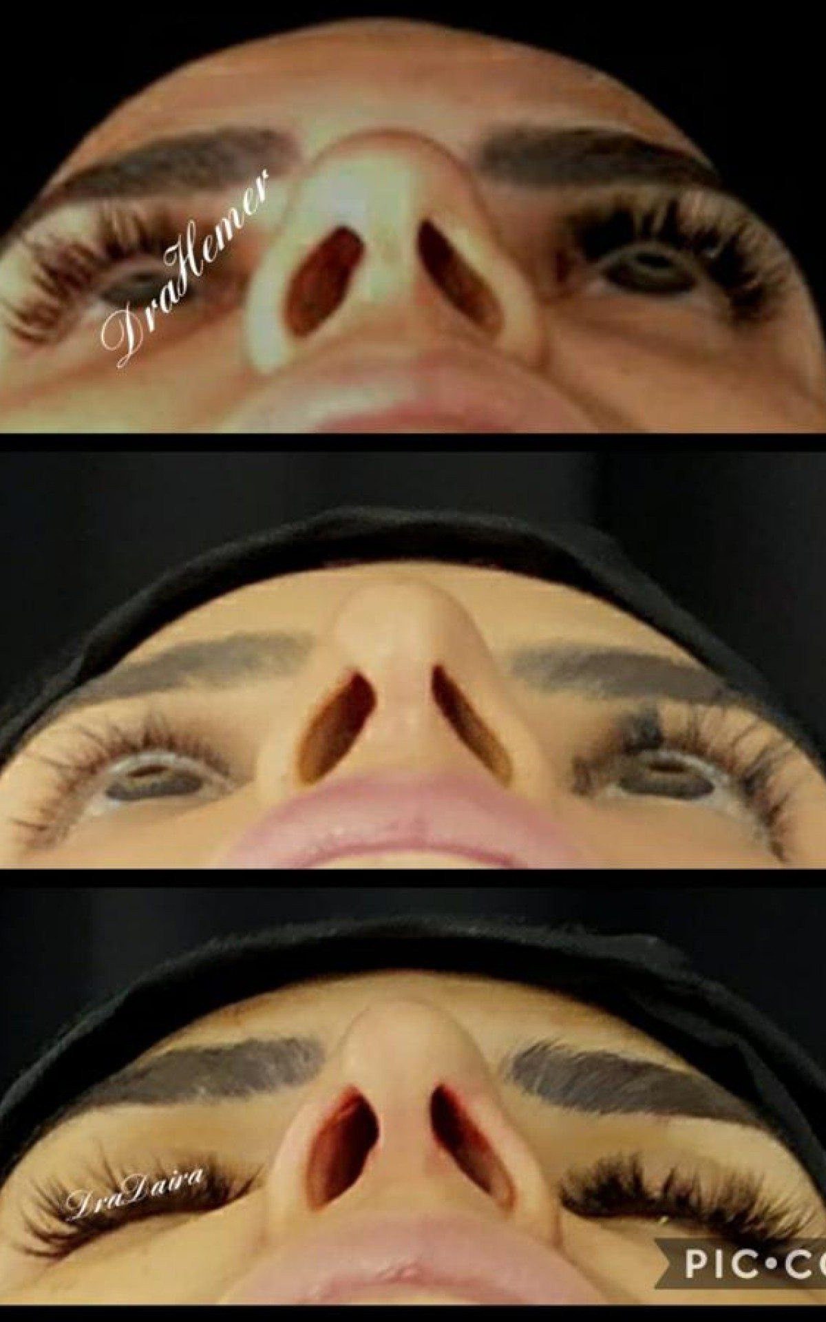 Antes e depois do procedimento de rinomodelação;