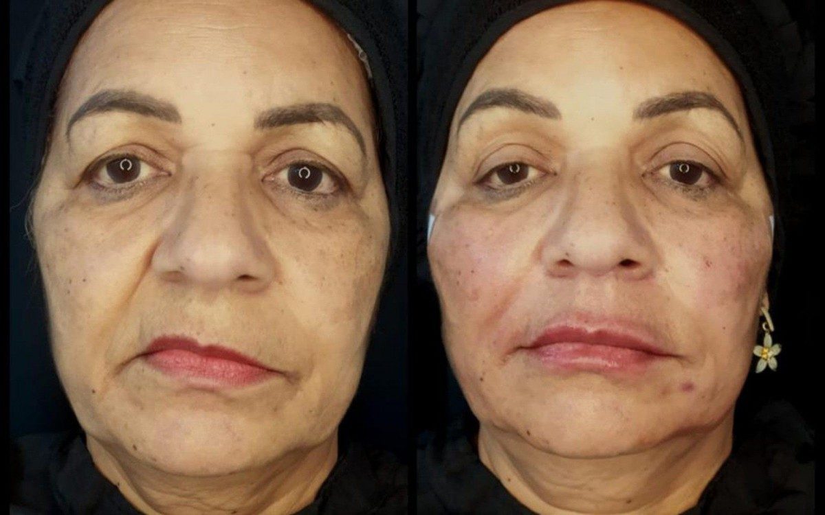 Antes e depois do procedimento feito na paciente com paralisia facial.