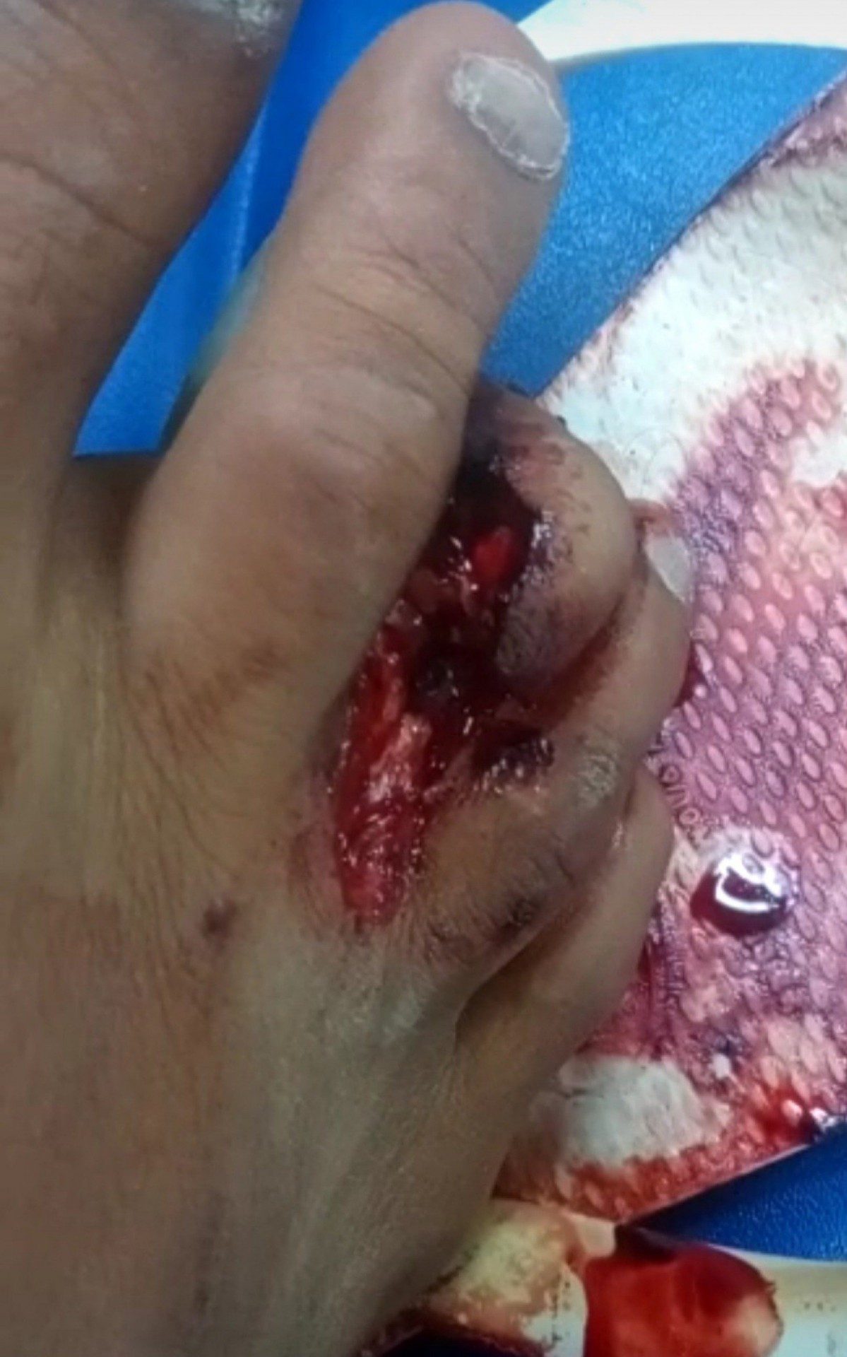 Mototaxista, Mario sofreu acidente e teve o dedo do p&eacute; comprometido, sendo necess&aacute;ria cirurgia para retirada de uma falange e coloca&ccedil;&atilde;o de ferro para firmar o dedo no lugar. No dia seguinte &agrave; alta ele voltou ao Hospital Souza Aguiar. Est&aacute; na sala verde h&aacute; 13 dias