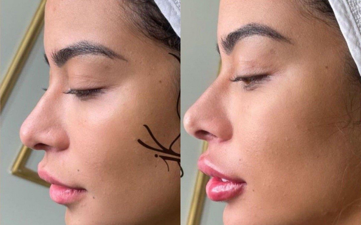 Rafaella Santos passa por procedimentos est&eacute;ticos e mostra antes e depois