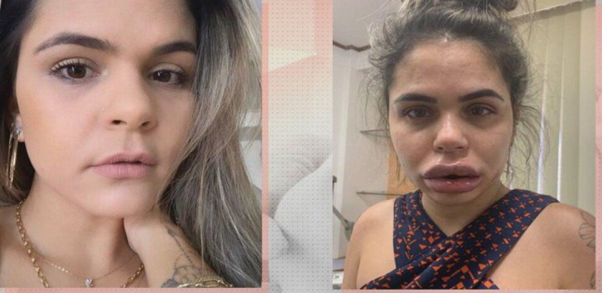 Dentista de Campos &eacute; acusada de deformar o rosto de pacientes em procedimentos est&eacute;ticos