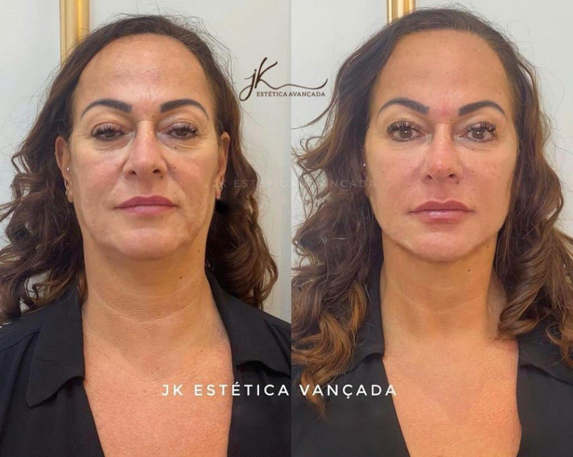 O antes e depois do rosto de dona Nadine Gonçalves - Reprodução Instagram