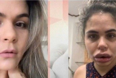 Alerta: cuidados ao fazer harmonização facial