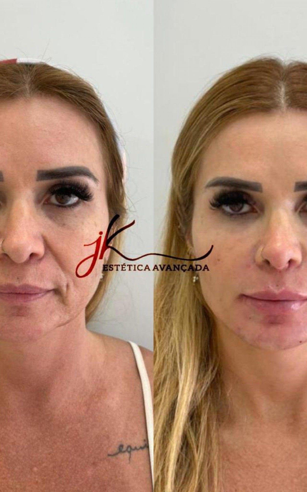 Antes e depois da harmoniza&ccedil;&atilde;o facial de Viviane Tube, m&atilde;e da ex-BBB Viih Tube