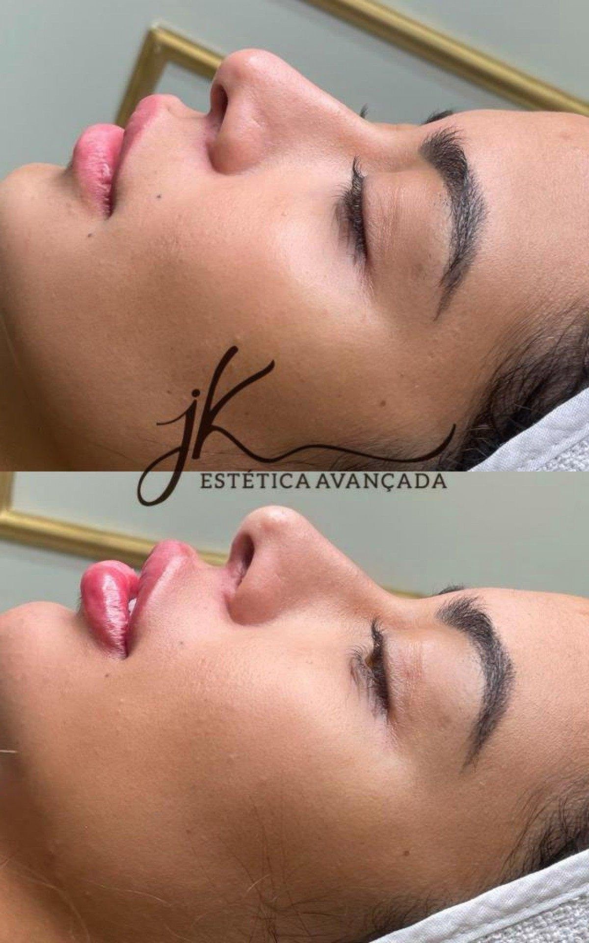 Antes e depois da harmoniza&ccedil;&atilde;o facial da influencer Rafaella Santos, irm&atilde; do jogador Neymar 