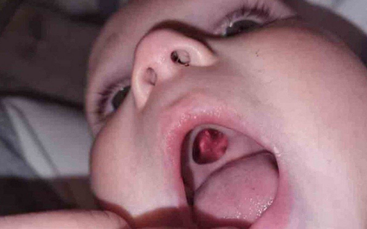 A m&atilde;e ficou desesperada ao encontrar &quot;buraco&quot; na boca do beb&ecirc;. 