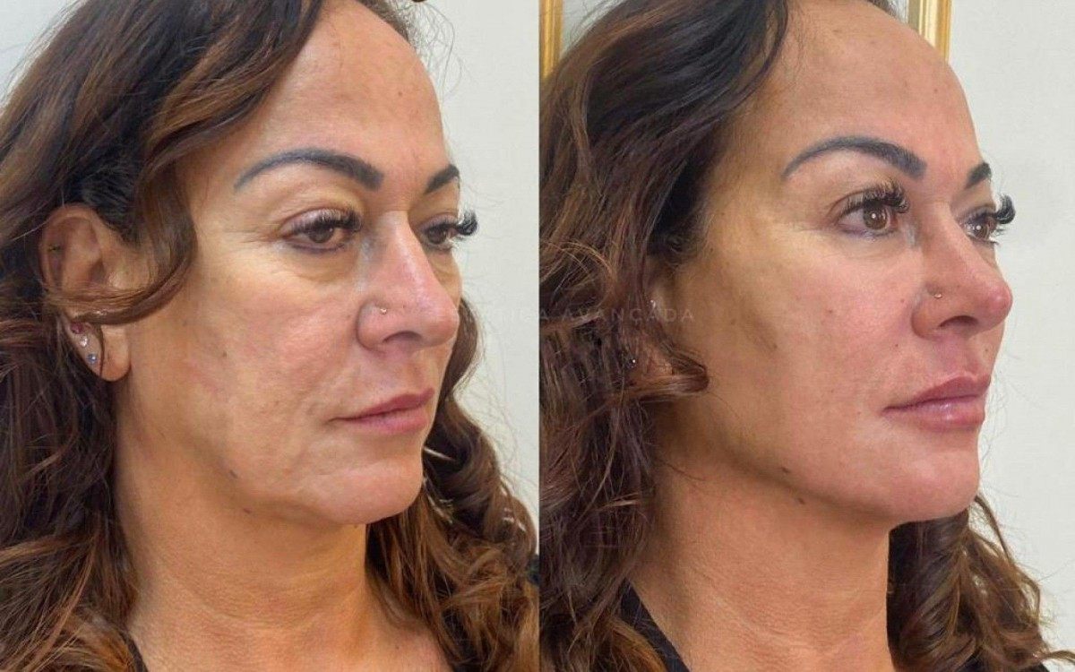 Antes e depois da harmoniza&ccedil;&atilde;o facial de Nadine Gon&ccedil;alves, m&atilde;e do jogador Neymar 