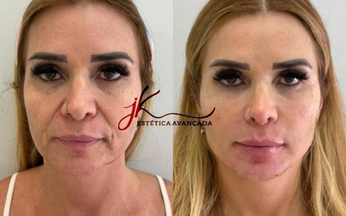 Antes e depois da harmonização facial de Viviane Tube, mãe da ex-BBB Viih Tube