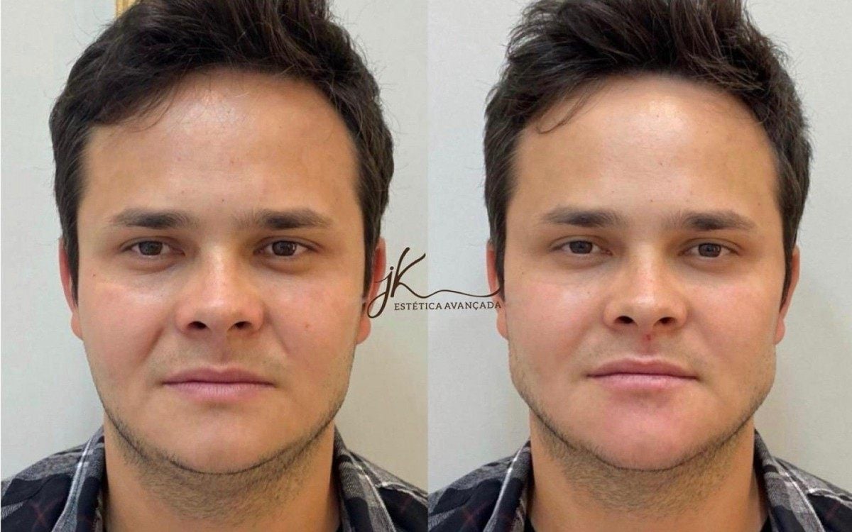 Antes e depois da harmonização facial do cantor Matheus, dupla de Kauan - Reprodução Instagram