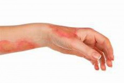 Dia Nacional de Luta Contra Queimaduras - Mais de 1 milhão de pessoas por ano sofrem queimaduras