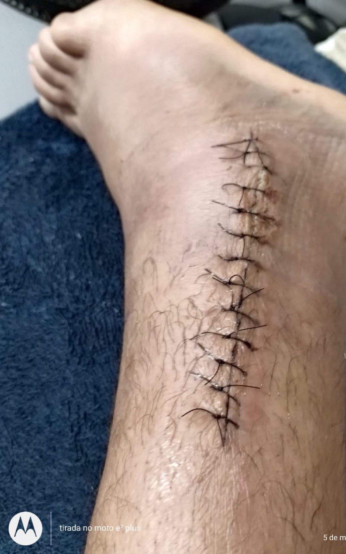 ele rompeu a f&iacute;bula e fraturou o quinto metatarso do p&eacute; direito