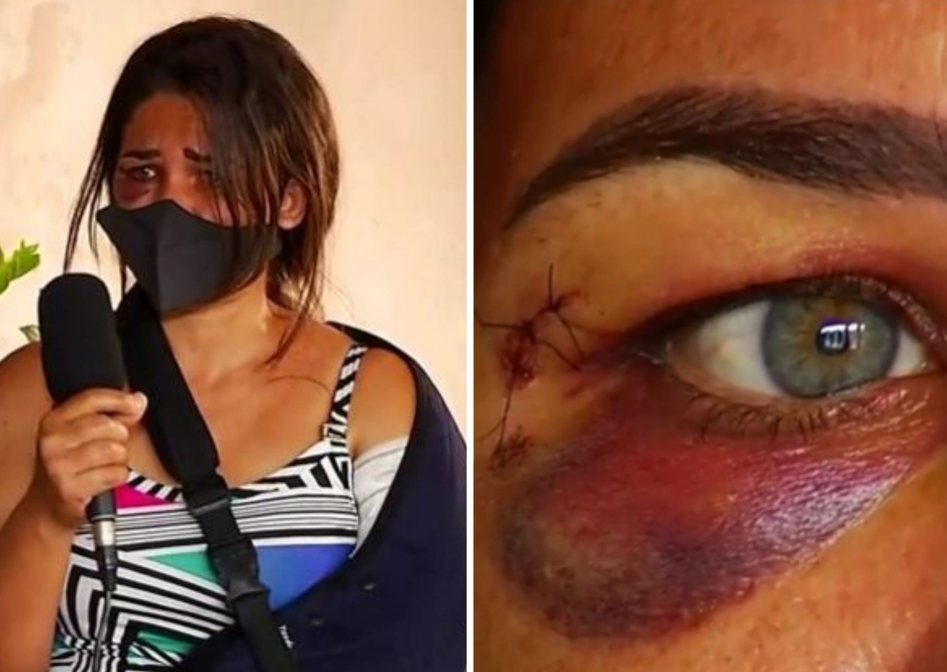 Funcion&aacute;ria de padaria &eacute; agredida e tem bra&ccedil;o quebrado ap&oacute;s pedir para cliente usar m&aacute;scara 