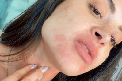 Aline Riscado mostra alergia causada pelos 16 gatos