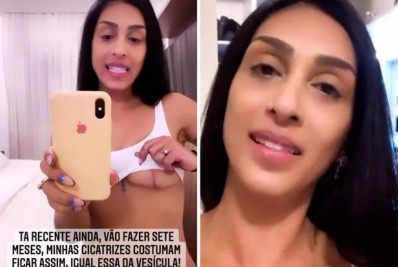 Ex-BBB Amanda Djehdian mostra cicatriz após retirar silicone