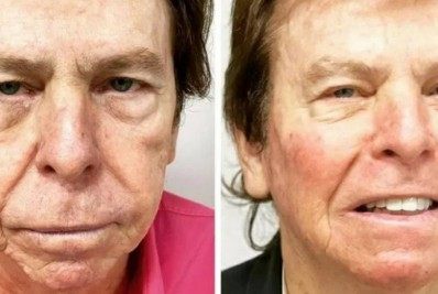 Aos 83 anos, Nelson Rubens passa por harmonização facial