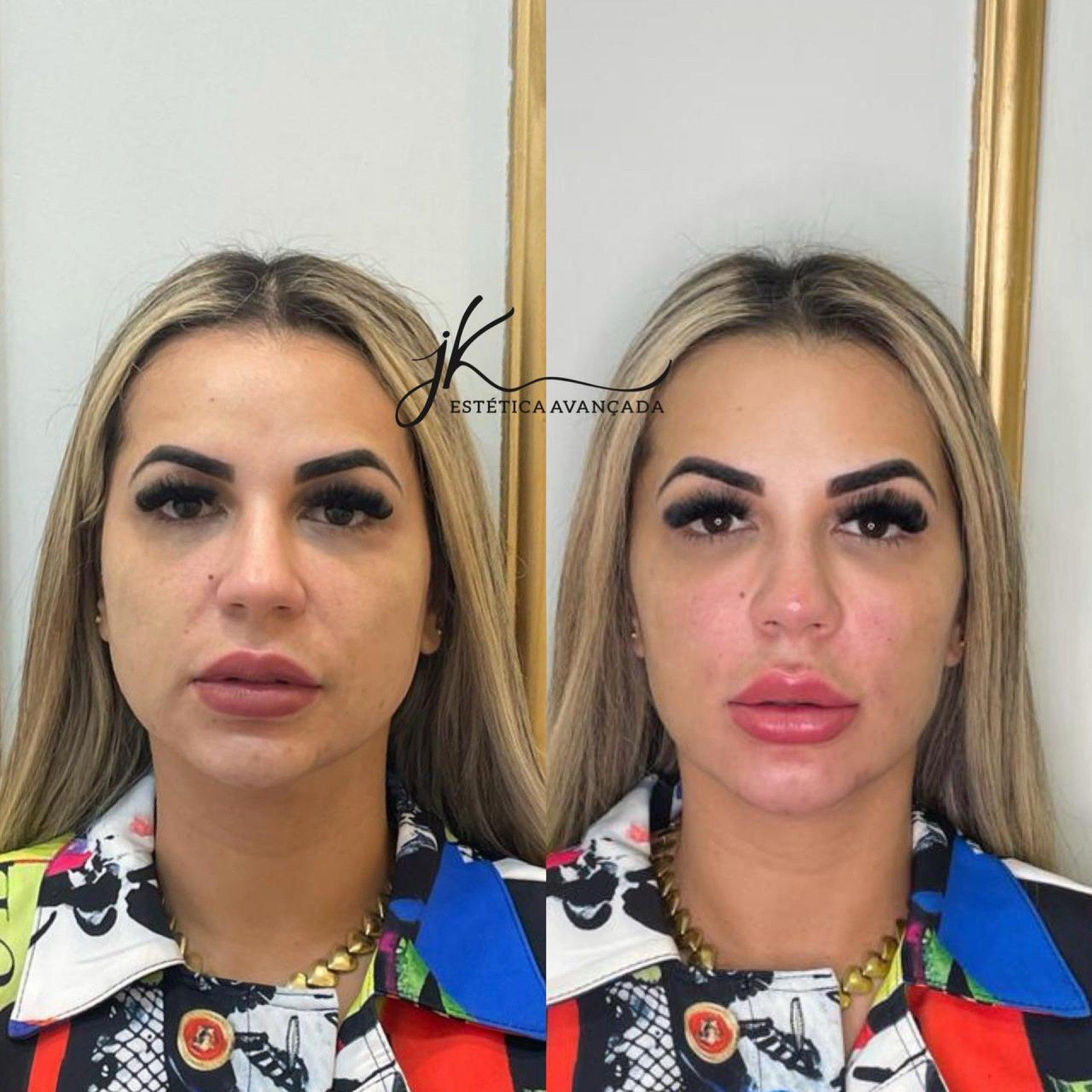 O antes e depois da harmonização facial de Deolane Bezerra - Divulgação 