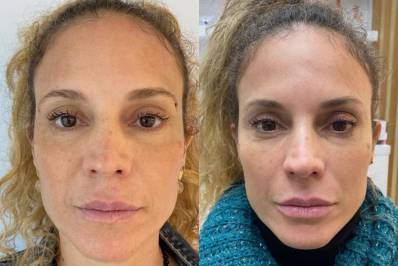 Maíra Charken faz nova harmonização facial