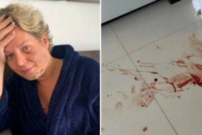 Com diversas fraturas, Joice Hasselmann aciona Polícia Legislativa para investigar suposto atentado