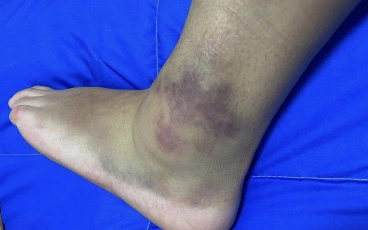 P&acirc;mela Rosa mostra tornozelo inchado ap&oacute;s deixar as Olimp&iacute;adas