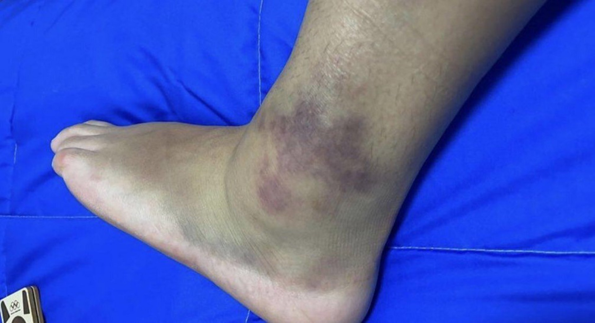 Pâmela Rosa mostra tornozelo inchado após deixar as Olimpíadas - Reprodução
