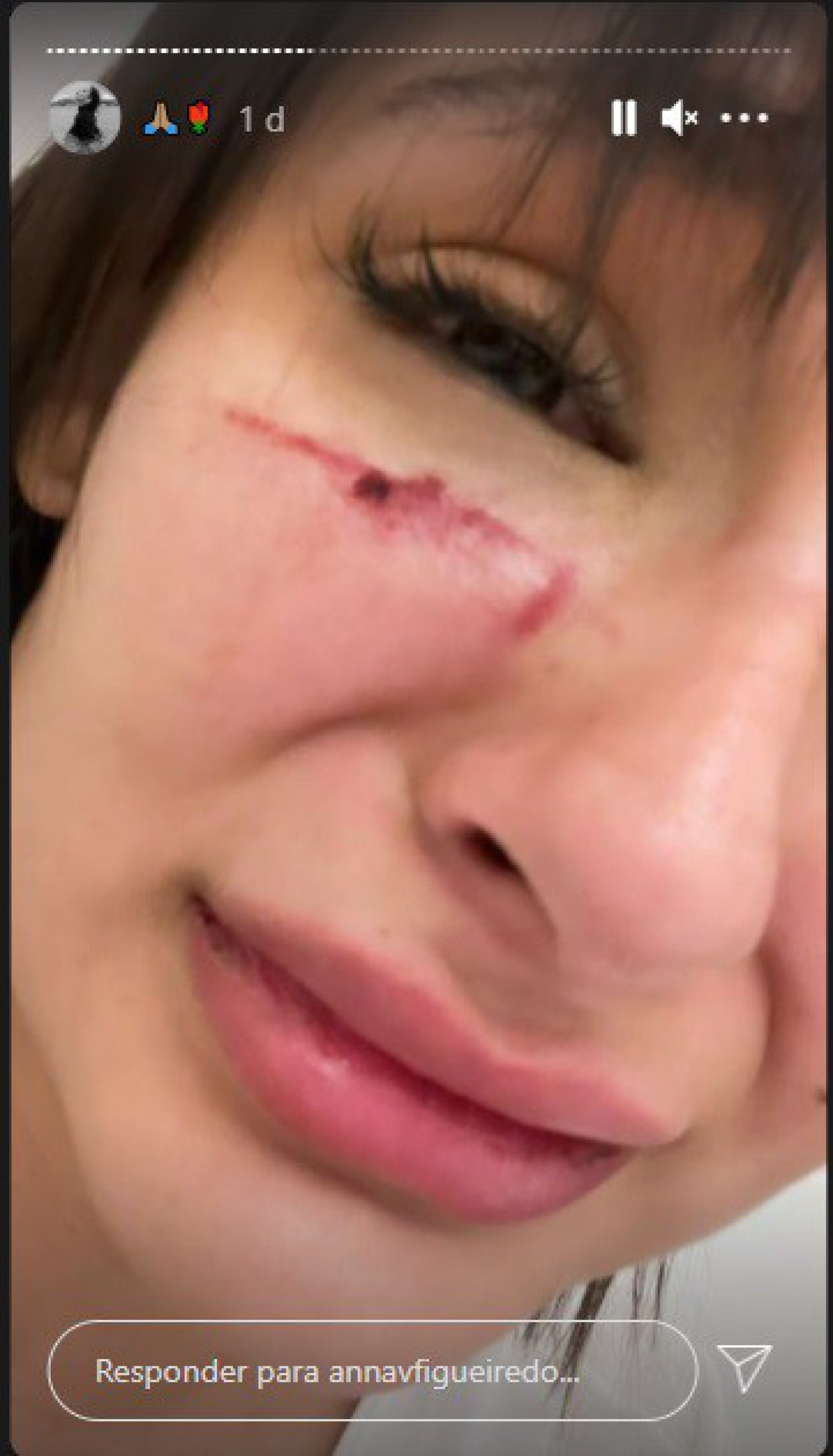 Modelo Anna Victória Figueiredo ficou com diversos hematomas após agressões - Reprodução