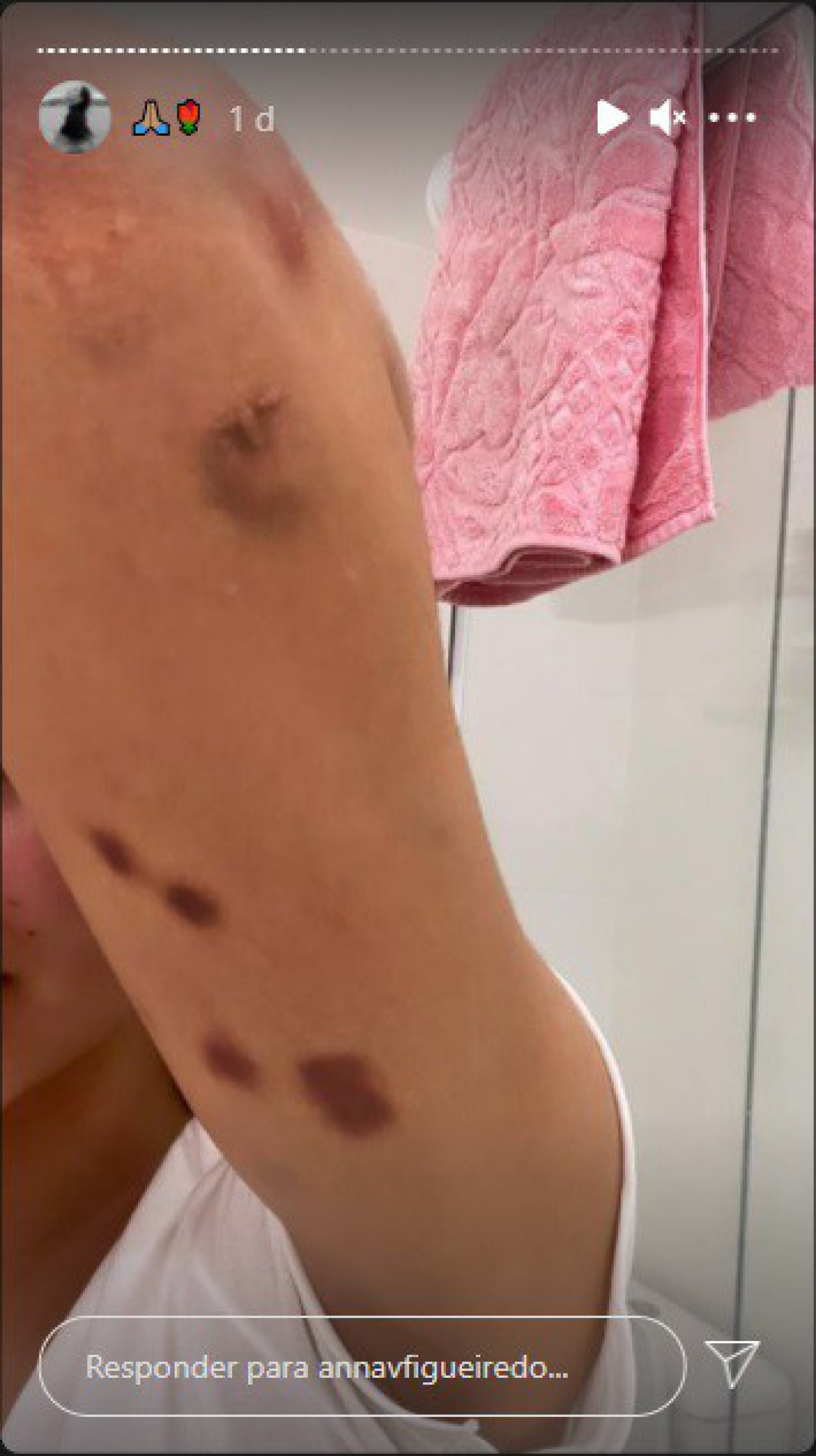 Modelo Anna Victória Figueiredo ficou com diversos hematomas após agressões - Reprodução