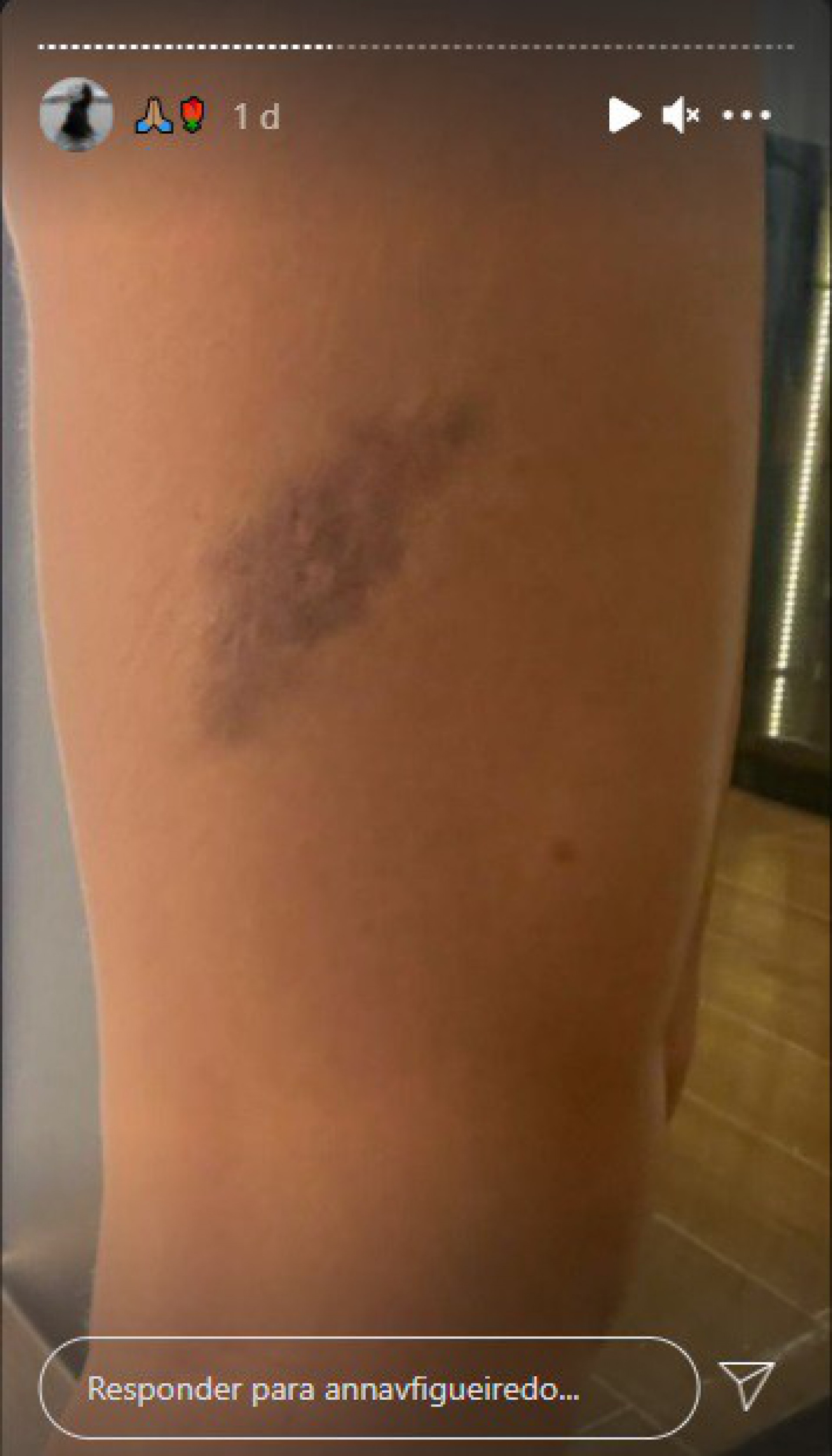 Modelo Anna Victória Figueiredo ficou com diversos hematomas após agressões - Reprodução