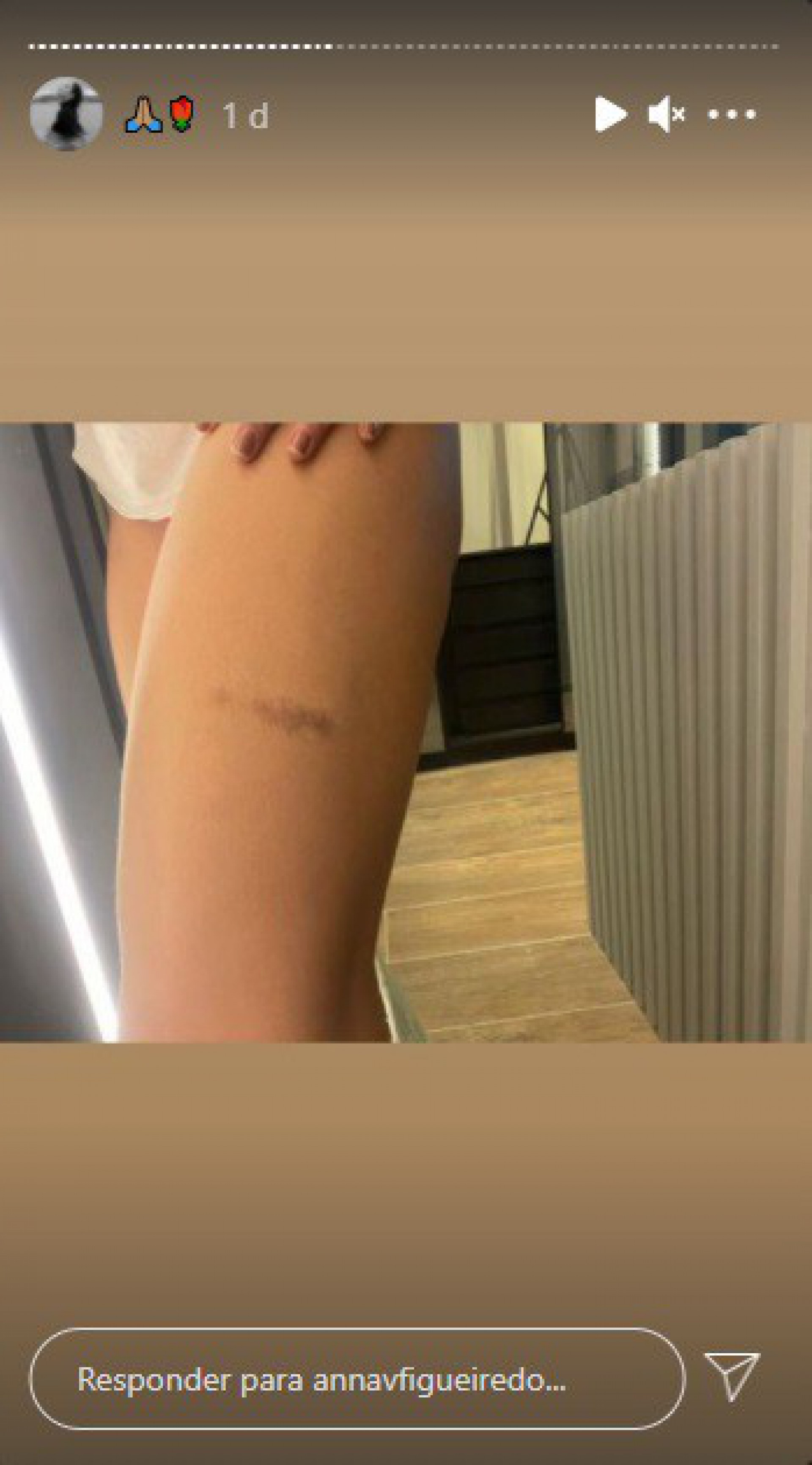 Modelo Anna Victória Figueiredo ficou com diversos hematomas após agressões - Reprodução