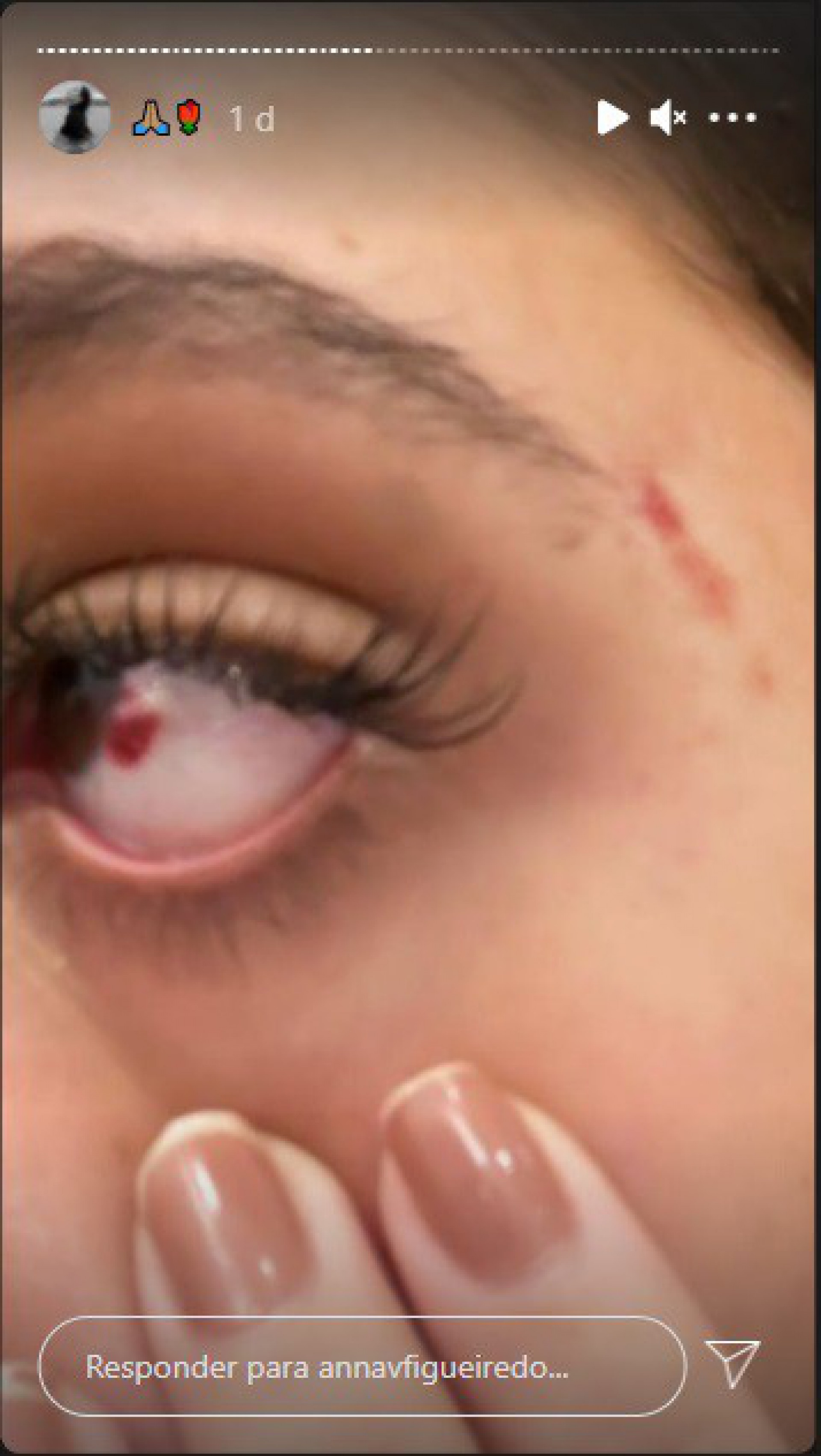 Modelo Anna Victória Figueiredo ficou com diversos hematomas após agressões - Reprodução