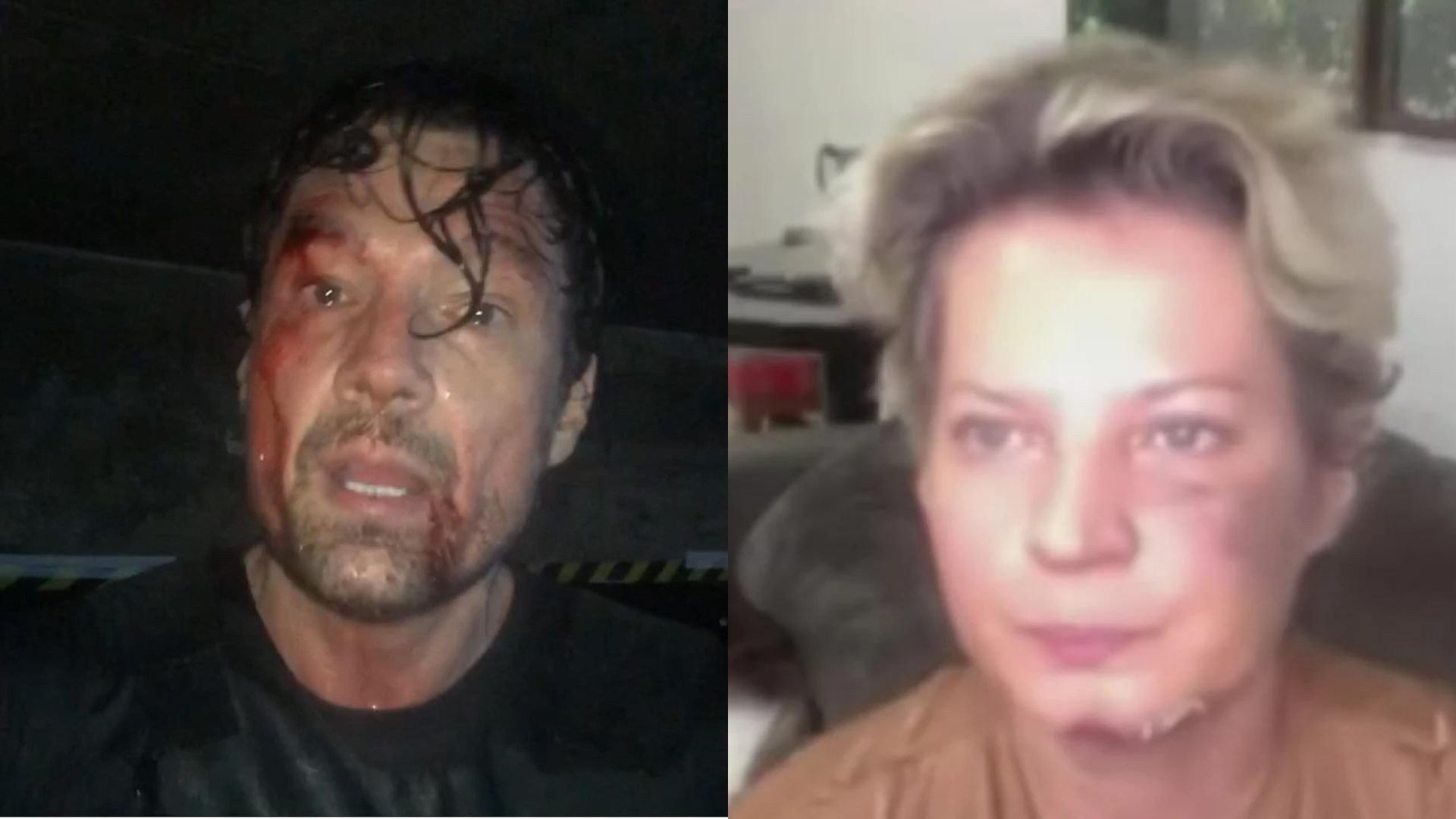 Ricardo Macchi surge machucado e ironiza suposto atentado contra Joice Hasselmann - Reprodução