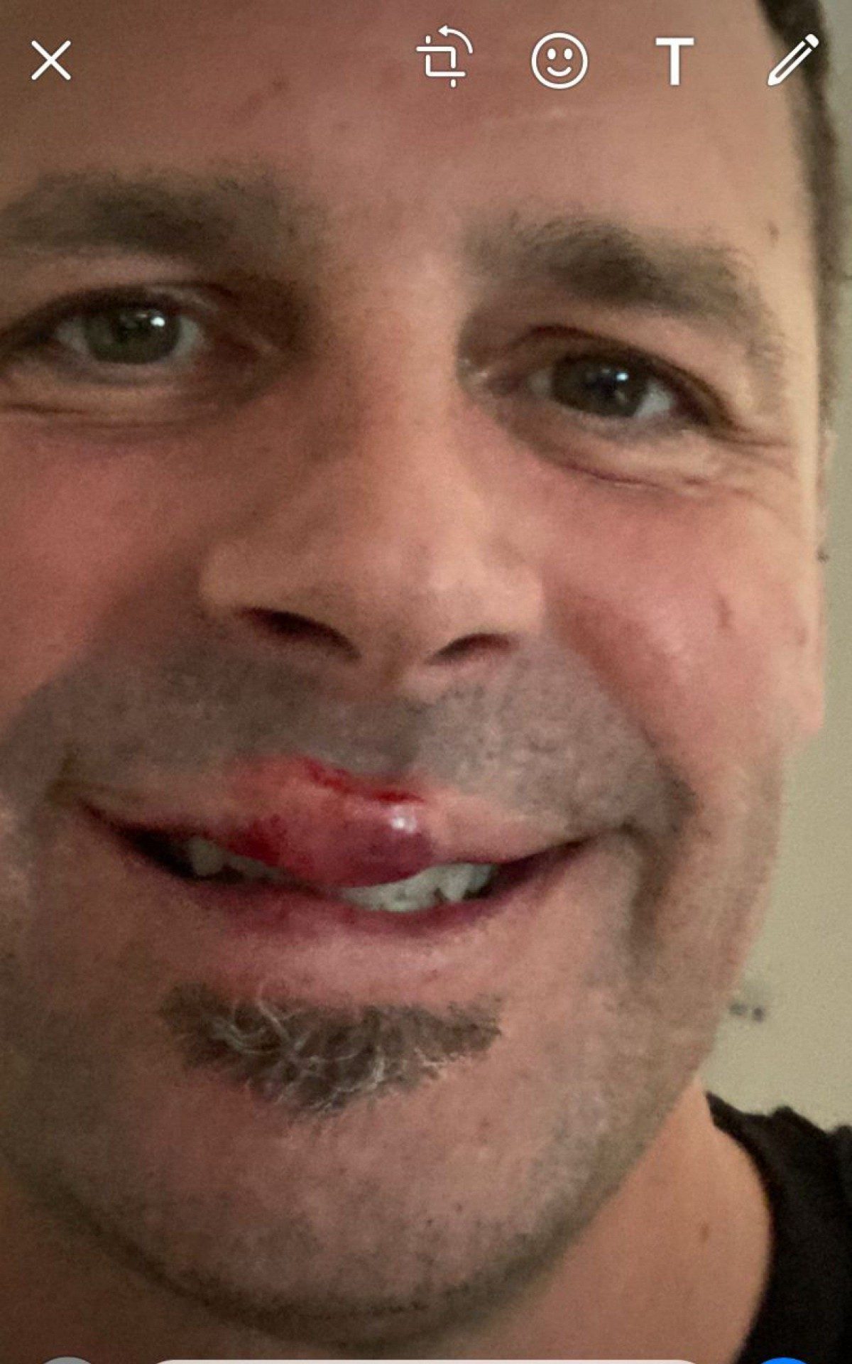 Foto de um dos ferimentos do americano causados pelos agressores.