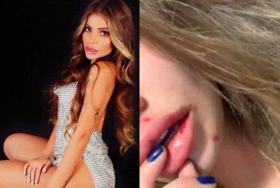 MC Bragança mostra hematomas e denuncia agressões