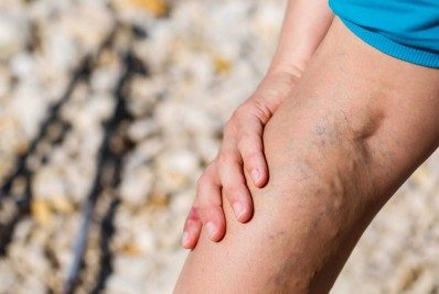 Saiba como cuidar das varizes