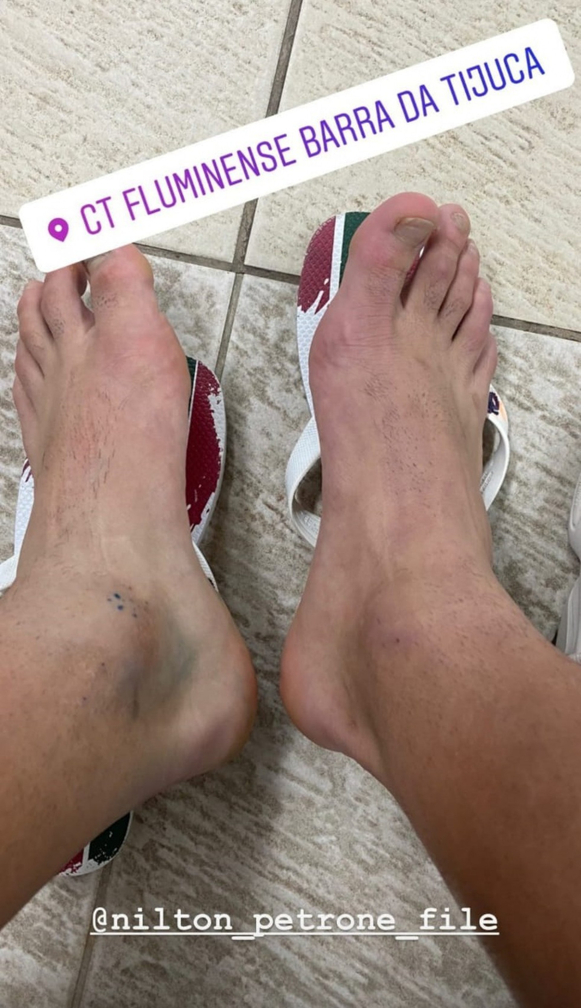 Meia do Fluminense mostra tornozelo inchado e diz que jogou com dor: 'Queria ajudar'