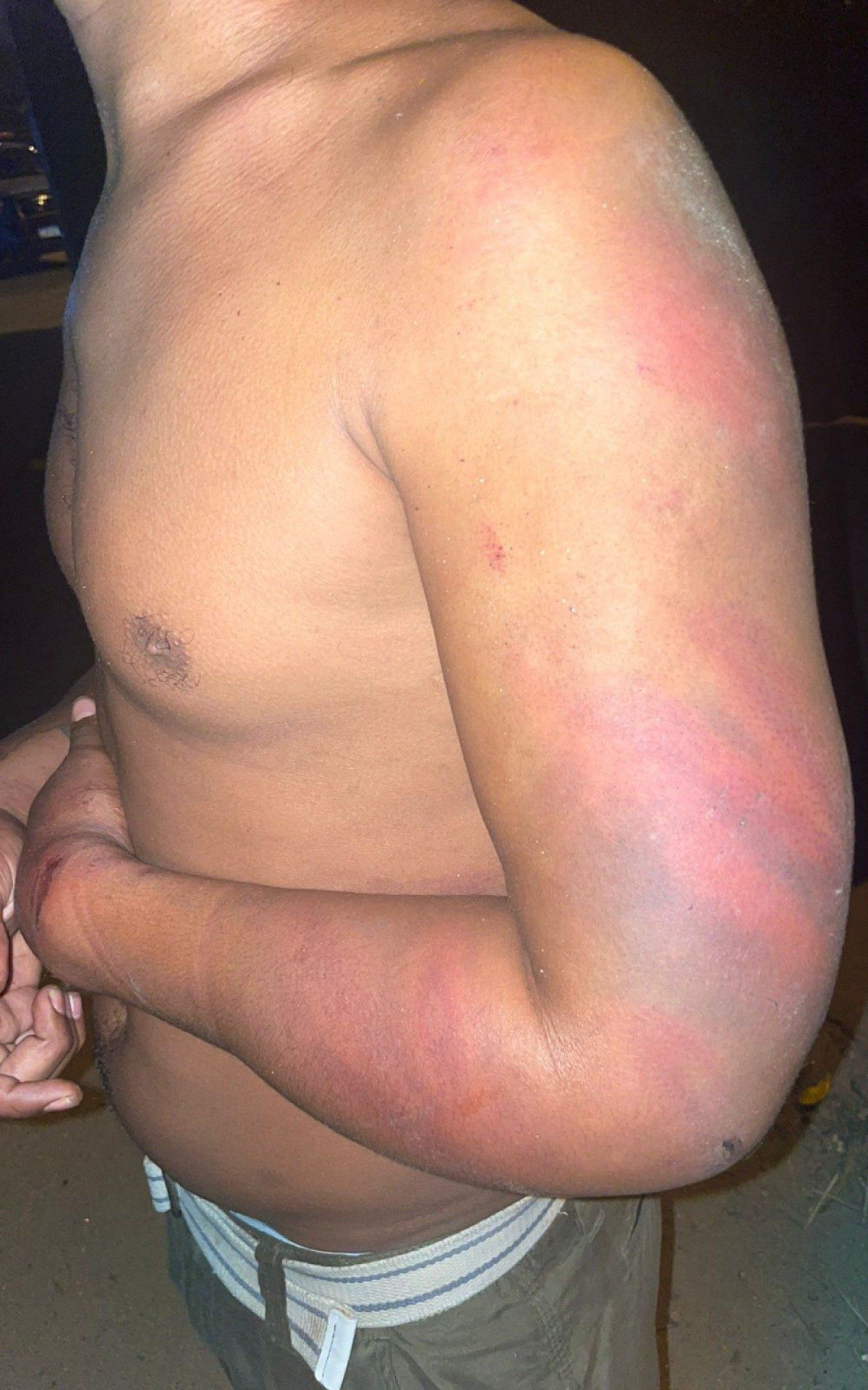 Homem sofreu escoriações pelo corpo após ser agredido por traficantes no Rebu - REPRODUÇÃO TWITTER