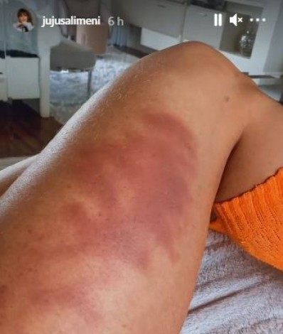 Juju Salimeni mostra hematomas no corpo - Reprodução