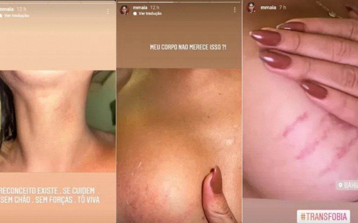 Marcella Maia mostra hematomas após ser vítima de ataque transfóbico - Reprodução/Instagram