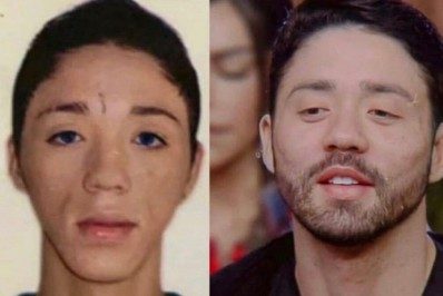 Rico Melquíades gastou R$ 70 mil em harmonização 