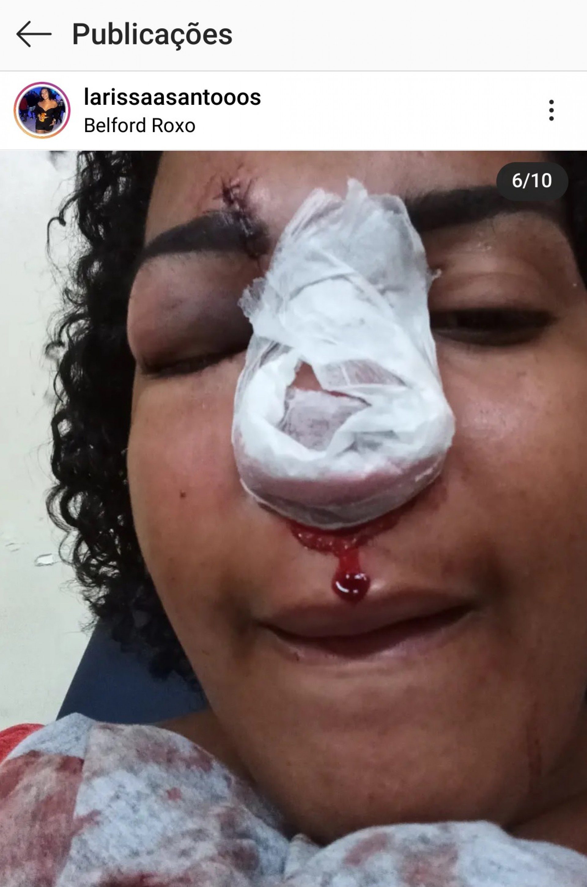 Larissa Santos recebeu sete pontos no nariz - Reprodu&ccedil;&atilde;o / Redes Sociais