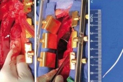 Médicos encontram pedaço de cimento no coração de paciente durante cirurgia