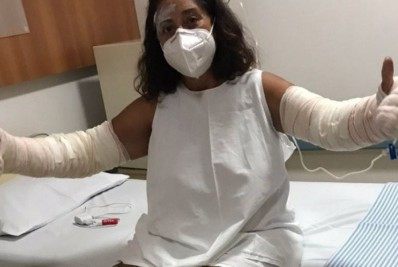 Professora tem 40% do corpo queimado após explosão de desodorante