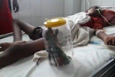 Adolescente passa por cirurgia de emergência após engolir 16 escovas de dente e 1 prego