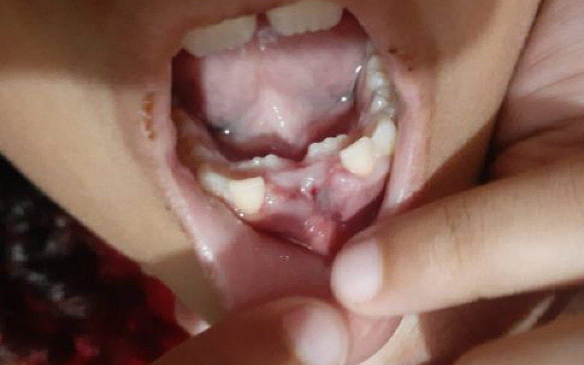 Segundo a mãe, a menina foi a consulta para extrair dois dentes de leite, diferente dos dois incisivos centrais permanentes  - Luiz Felipe Rodrigues (RC24h)