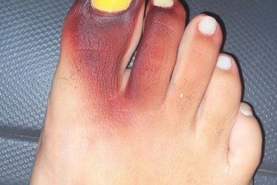 Mulher fica com dedos roxos após calçar tênis com piolho-de-cobra