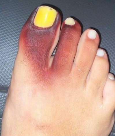 Mulher fica com dedos roxos após calçar tênis com piolho-de-cobra | Rio de  Janeiro | O Dia