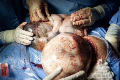 Fotógrafa de Cabo Frio registra parto raríssimo de gêmeos empelicados