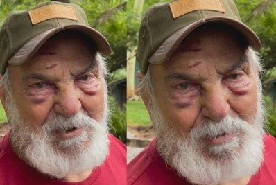 'Levei um tombo, mas não caí', afirma Lima Duarte ao surgir com o rosto machucado