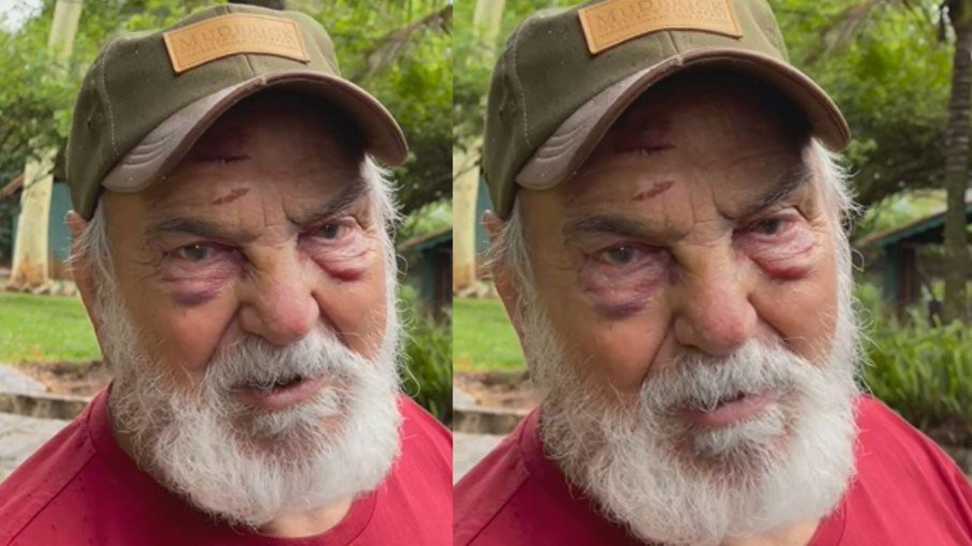 Lima Duarte preocupa fãs ao surgir com o rosto machucado e olhos roxos - Reprodução/Instagram